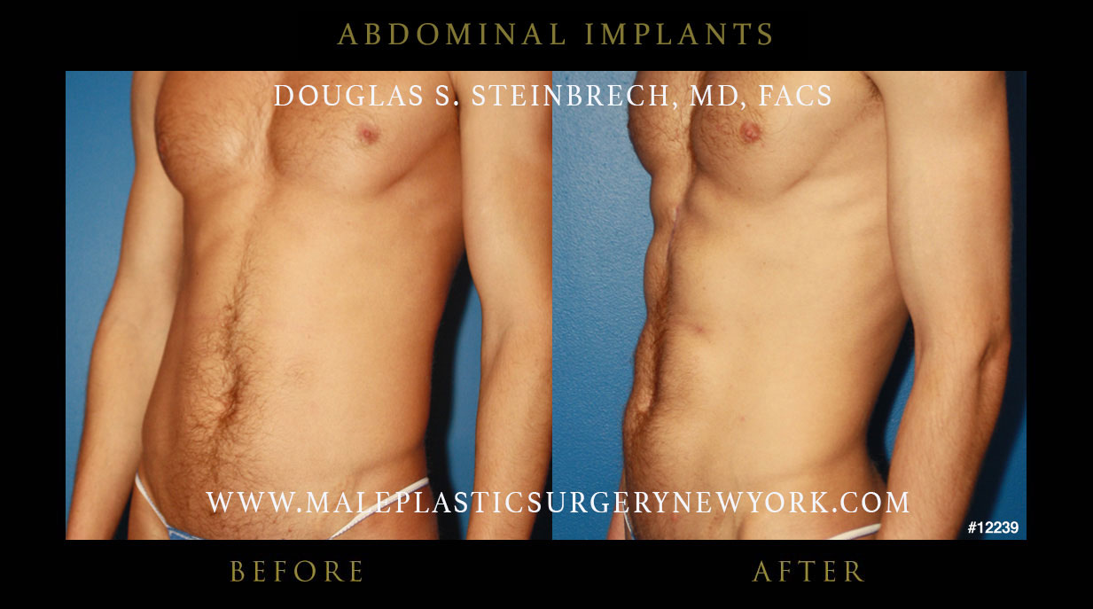 ab implants for men in chicago