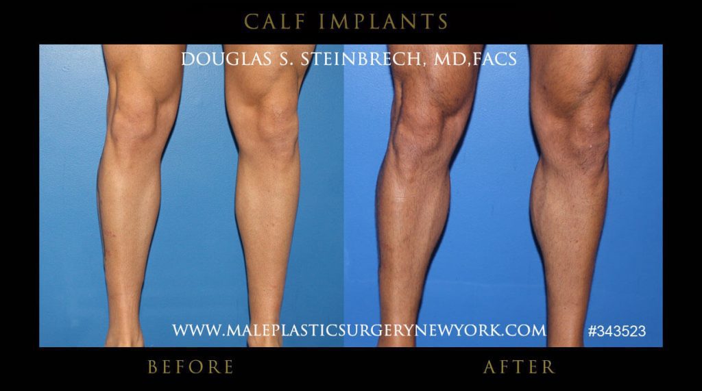 Calf Implants Male Plastic Surgery Chicago