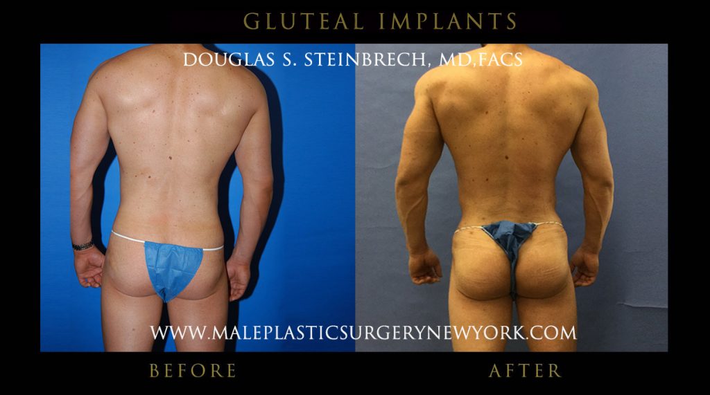butt implants for men in chicago