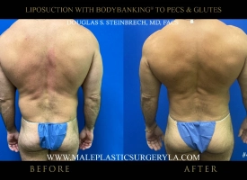 liposuction-bodybanking-chicago-before-after-posterior-view