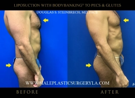 male-lipo-bodybanking-chicago-before-after-right-side