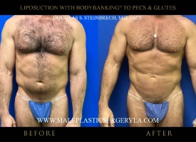 male-liposuction-bodybanking-chicago-before-after-frontal