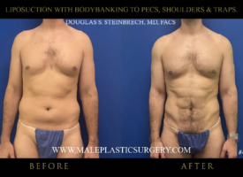 Liposuction before-and-after comparison showcasing male patient results, highlighting body contouring of pecs, shoulders, and traps, performed by Dr. Douglas Steinbrech at Male Plastic Surgery Chicago.