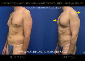 Before-and-after comparison of male liposuction results highlighting body banking to pectorals, shoulders, and traps, showcasing significant transformation in physique.