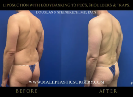 Before and after images of male liposuction procedure showcasing body banking to enhance pectorals, shoulders, and traps, featuring a male patient in a blue thong against a neutral background.