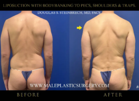 Liposuction before-and-after comparison showcasing bodybanking to pectorals, shoulders, and traps, highlighting transformation in male physique by Dr. Douglas Steinbrech.