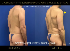 Liposuction before and after image showcasing bodybanking to pecs, shoulders, and traps, highlighting transformation in male physique by Dr. Douglas Steinbrech.