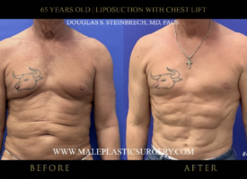 65yo-male-lipo-chestlift-before-after-chicago