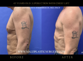 65yo-male-lipo-chestlift-left-side-chicago