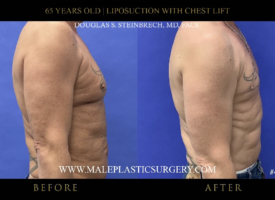 65yo-male-lipo-chestlift-right-side-chicago
