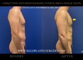Before-and-after image of male liposuction procedure highlighting body banking to pectorals, shoulders, and traps, showcasing significant transformation, with "Before" and "After" labels and Dr. Douglas Steinbrech's branding.