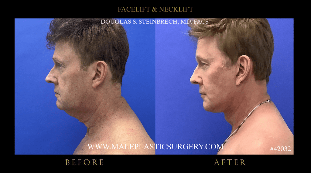 Before and after male facelift results, Chicago plastic surgery patient.