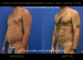 lipo-bodybanking-pecs-shoulders-traps-45degree-left-chicago