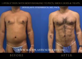lipo-bodybanking-pecs-shoulders-traps-before-after-chicago