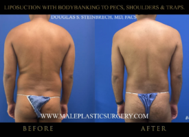 lipo-bodybanking-pecs-shoulders-traps-glutes-straight-on-chicago