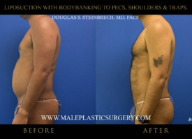 lipo-bodybanking-pecs-shoulders-traps-side-profile-chicago