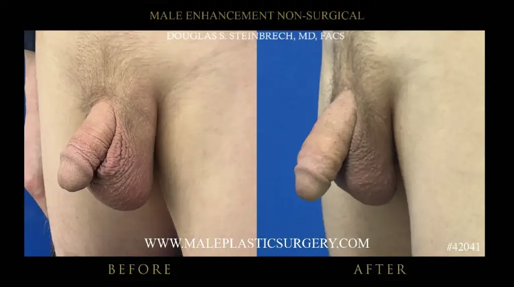 Before and after images of non-surgical penile augmentation by Dr. Douglas Steinbrech, showcasing enhanced male anatomy results.