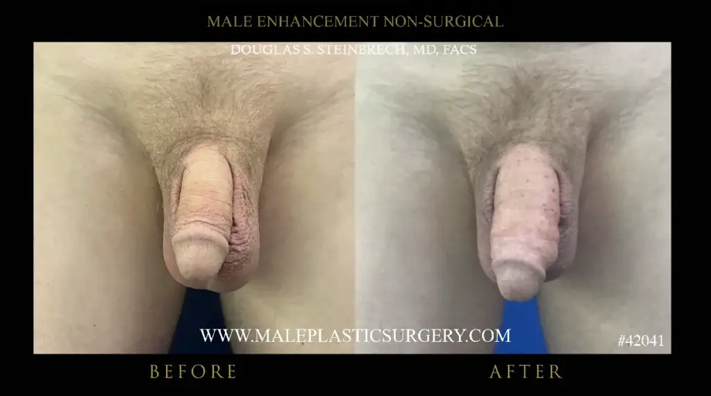 Before and after images of non-surgical penile augmentation, showcasing results from Dr. Douglas Steinbrech at Male Plastic Surgery Chicago.