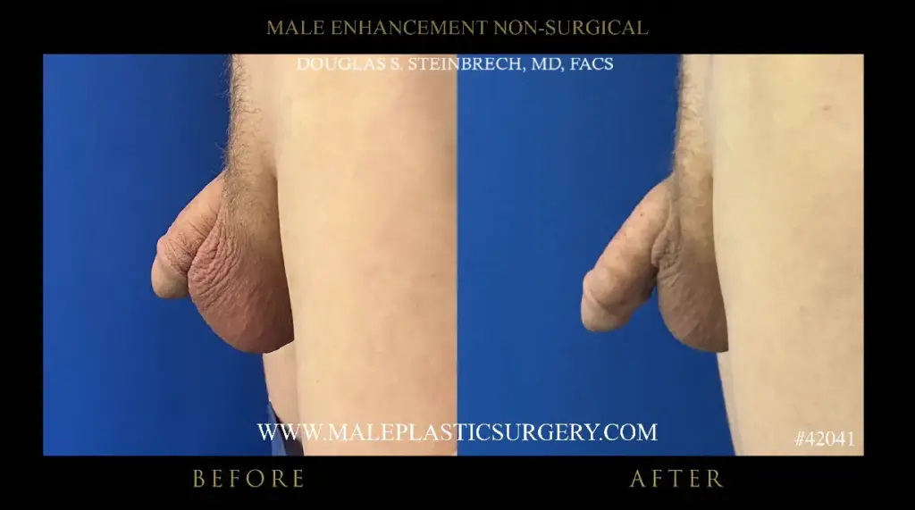 Non-surgical penile augmentation before and after comparison by Dr. Douglas Steinbrech, showcasing enhanced results in male enhancement procedures.