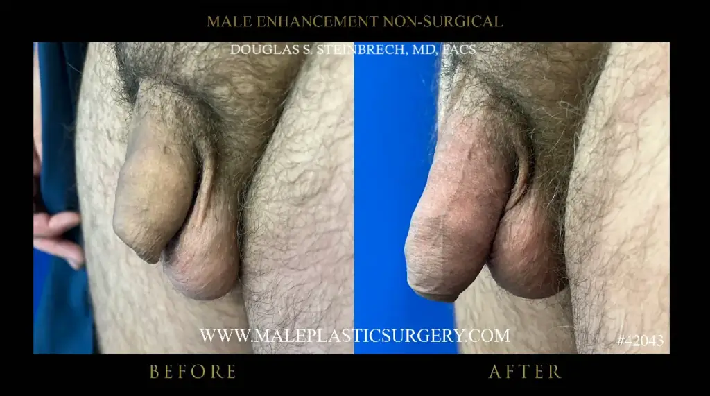 Before and after images of non-surgical penile augmentation, showcasing results from Dr. Douglas Steinbrech at Male Plastic Surgery Chicago.