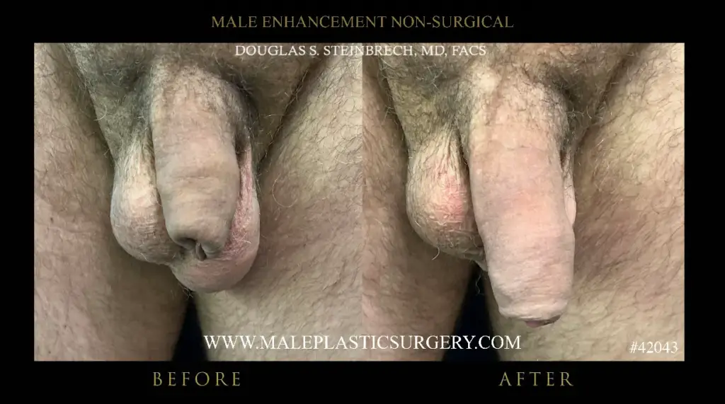 Before and after image of non-surgical penile augmentation results by Dr. Douglas Steinbrech, showcasing enhancement effects.
