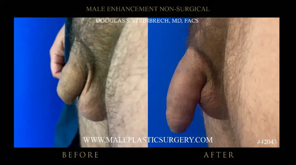 Before and after images of non-surgical penile augmentation by Dr. Douglas Steinbrech, showcasing enhanced penile appearance.