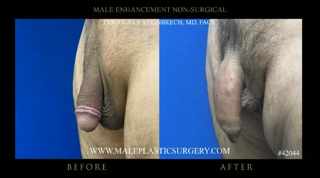 Before and after images of non-surgical penile augmentation, showcasing results from Dr. Douglas Steinbrech at Male Plastic Surgery Chicago.