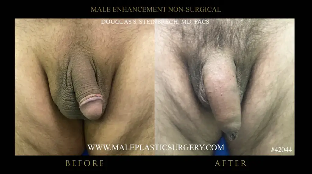 Before and after images of non-surgical penile enhancement procedure by Dr. Douglas Steinbrech, showcasing results in male genital aesthetics.
