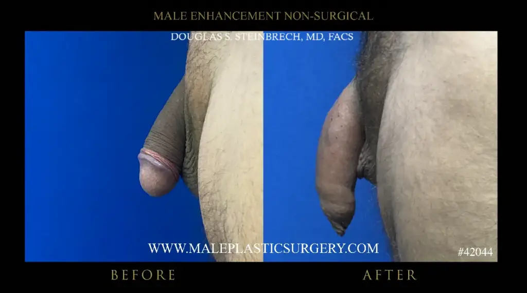 Non-surgical penile augmentation before and after image showcasing results from Dr. Douglas Steinbrech, highlighting enhanced size and appearance.