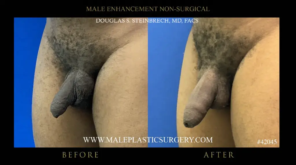 Before and after images of non-surgical penile augmentation, showcasing results from Dr. Douglas Steinbrech at Male Plastic Surgery Chicago.