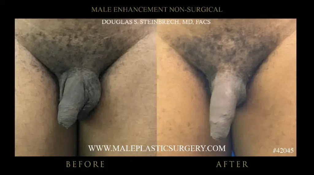 Before and after images of non-surgical penile augmentation procedure by Dr. Douglas Steinbrech, highlighting visible enhancement results.